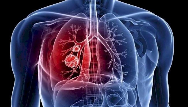 Marília confirma sétima morte por tuberculose em 2024 e aumento de 20% nos casos